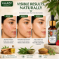 Scar Removal Serum (Pure Mix of Sandalwood Oil, Steam Distilled Neem & Fenugreek Extract) - Reduces Acne, Dark Spots & Pigmentation (Pack of 2 x 10 ml)